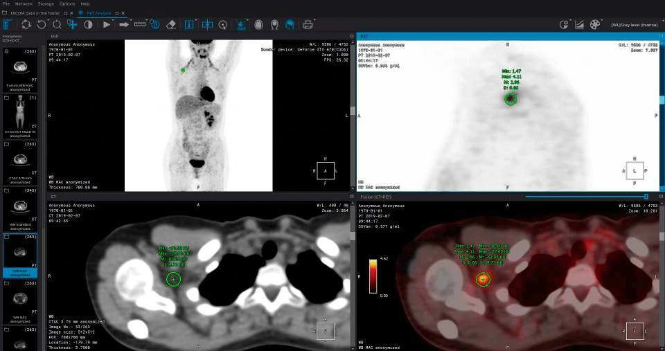 Captura de INOBITEC con vistas PET, CT y fusión PET/CT